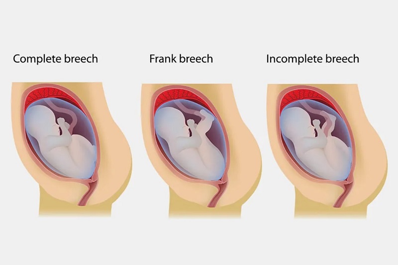 Có 3 loại ngôi thai ngược phổ biến 