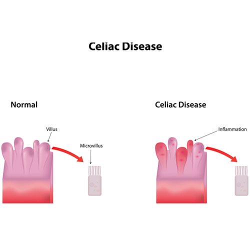 Bệnh celiac