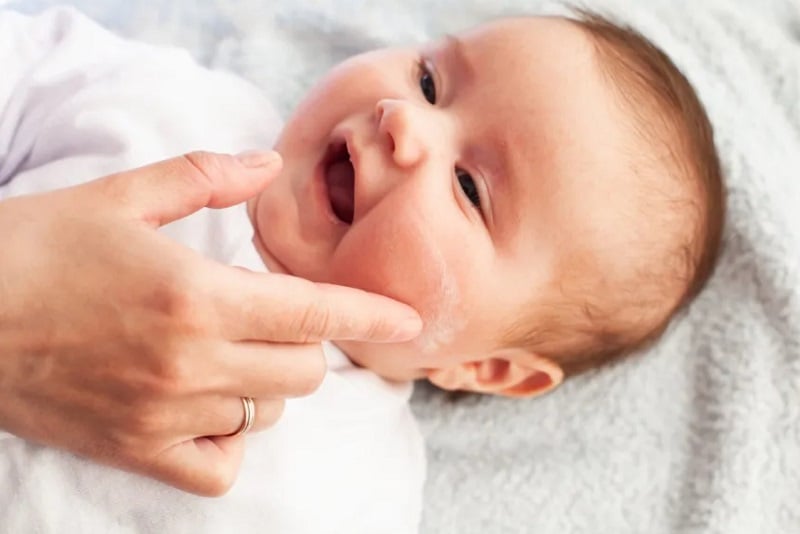 Chàm sữa có tự hết được không?