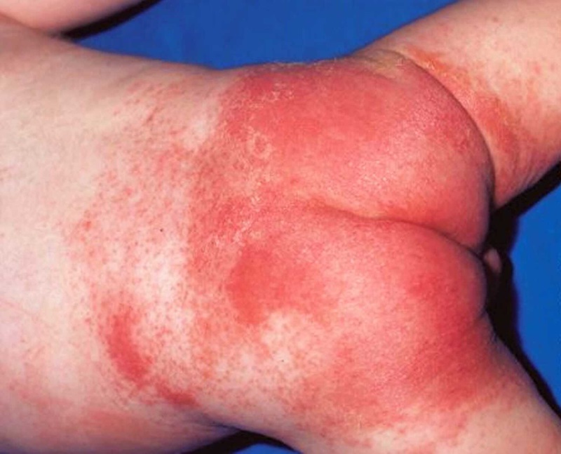 Kem chống hăm cho bé giúp điều trị hăm tã hiệu quả