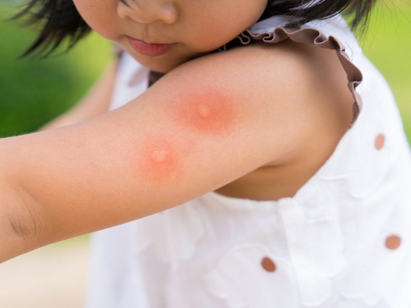 Nổi phát ban, da sưng huyết ửng đỏ là một trong những dấu hiệu trẻ bị sốt xuất huyết