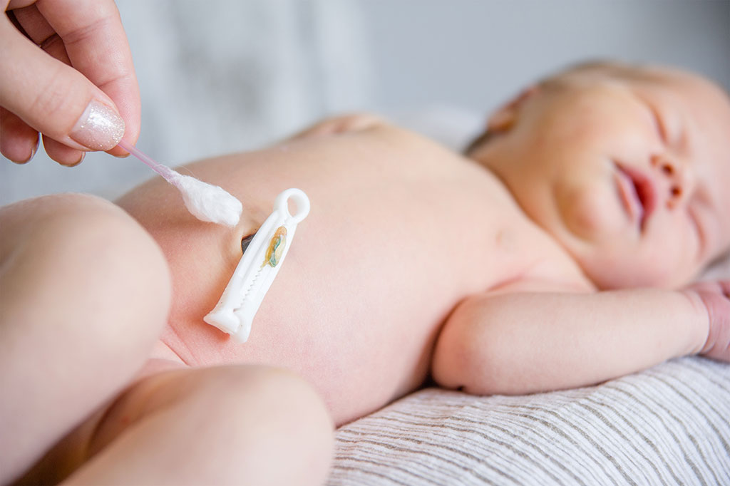 Cách chăm sóc rốn sau khi cắt: Điều nhỏ nhưng không thể lơ là Cách chăm sóc rốn sau khi cắt: Điều nhỏ nhưng không thể lơ là