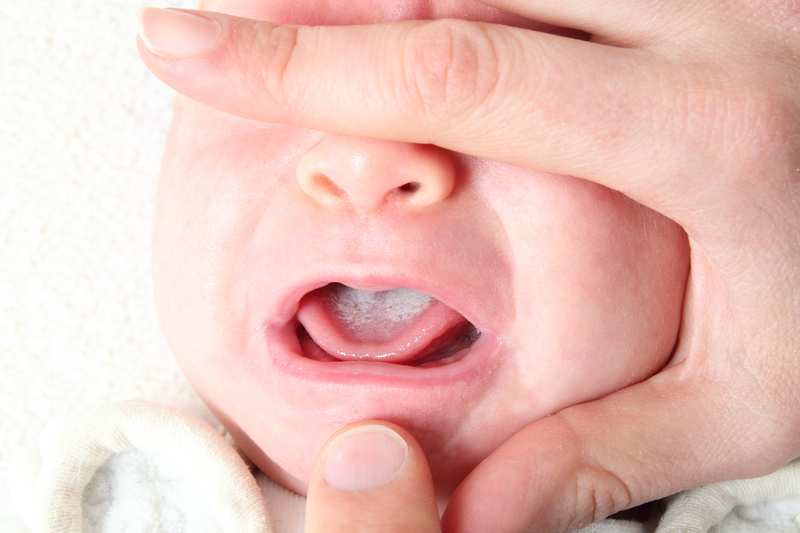 nấm lưỡi ở trẻ sơ sinh