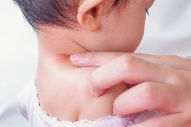 Trẻ bị hăm cổ là bệnh lý dễ gặp ở giai đoạn sơ sinh 
