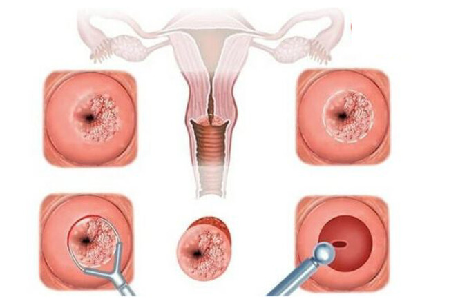 Khí hư bất thường, có màu trắng đục có thể do viêm cổ tử cung