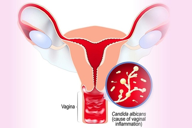 Khí hư màu vàng có thể là dấu hiệu của bệnh nhiễm trùng nấm Candida