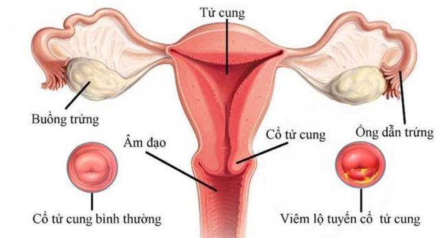 Viêm lộ tuyến cổ tử cung có thể gây xuất khí hư màu xanh hoặc vàng nhạt