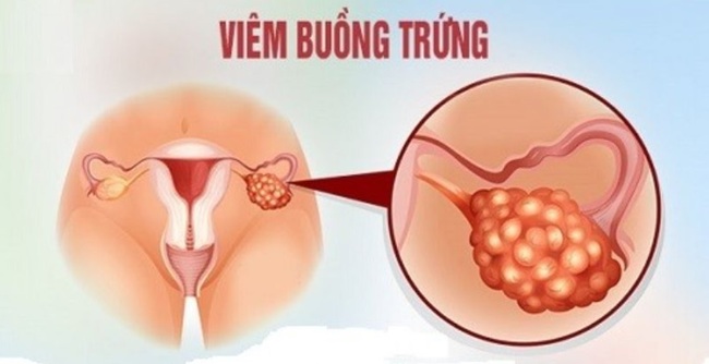 Khí hư màu xanh cũng là một dấu hiệu của bệnh viêm nhiễm ở vòi trứng