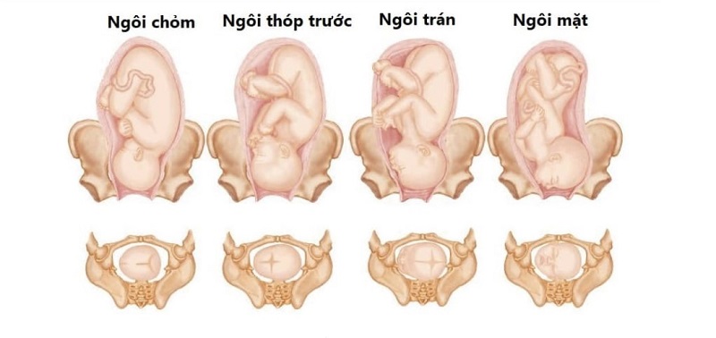 Ngôi thai thuận gồm 4 dạng là ngôi chỏm, ngôi thóp trước, ngôi trán, ngôi mặt 