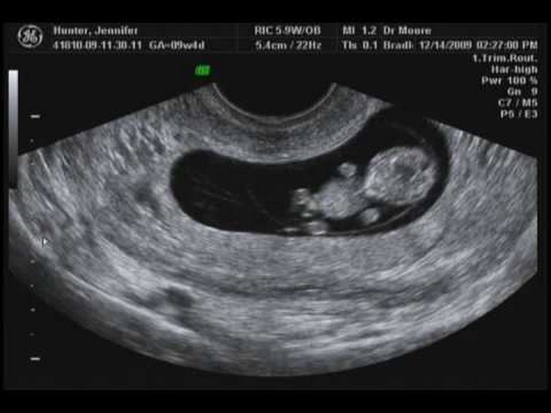 Hình ảnh siêu âm thai 10 tuần 
