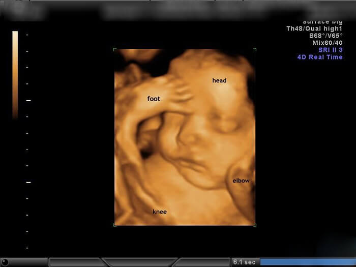 Hình ảnh siêu âm 4D thai nhi 16 tuần tuổi