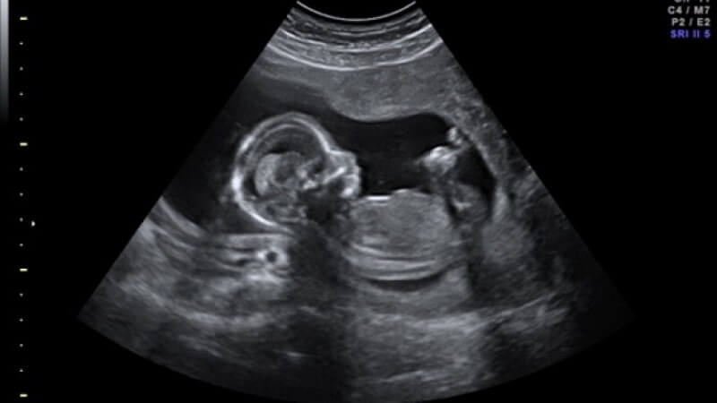 Hình ảnh siêu âm thai nhi 16 tuần tuổi
