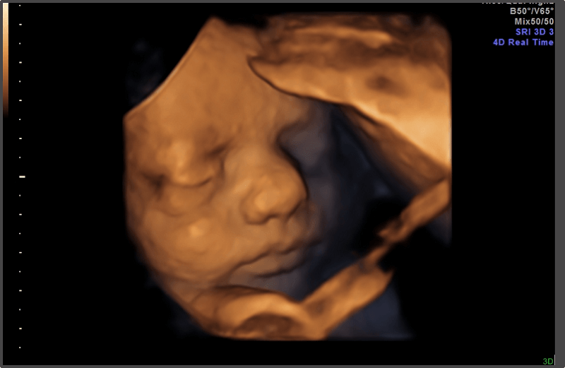 Hình ảnh siêu âm thai 34 tuần