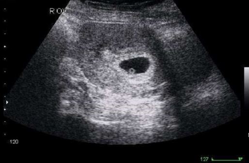 Hình ảnh siêu âm thai nhi 4 tuần tuổi