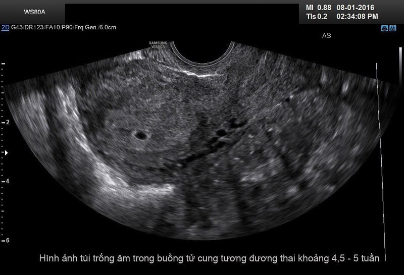Hình ảnh túi trống âm khi thai 5 tuần tuổi