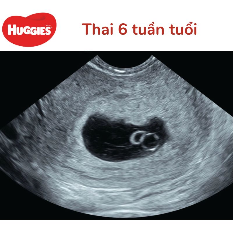 Thai nhi 6 tuần chào mừng bạn đến với giai đoạn quan trọng đầu tiên trong sự phát triển của bé! Bức ảnh này sẽ cho thấy thai nhi đang phát triển như thế nào, giúp các bậc cha mẹ hiểu rõ hơn về thai kỳ và cũng là một trải nghiệm tuyệt vời để chiêm ngưỡng sắc đẹp của sự sống mới nở.