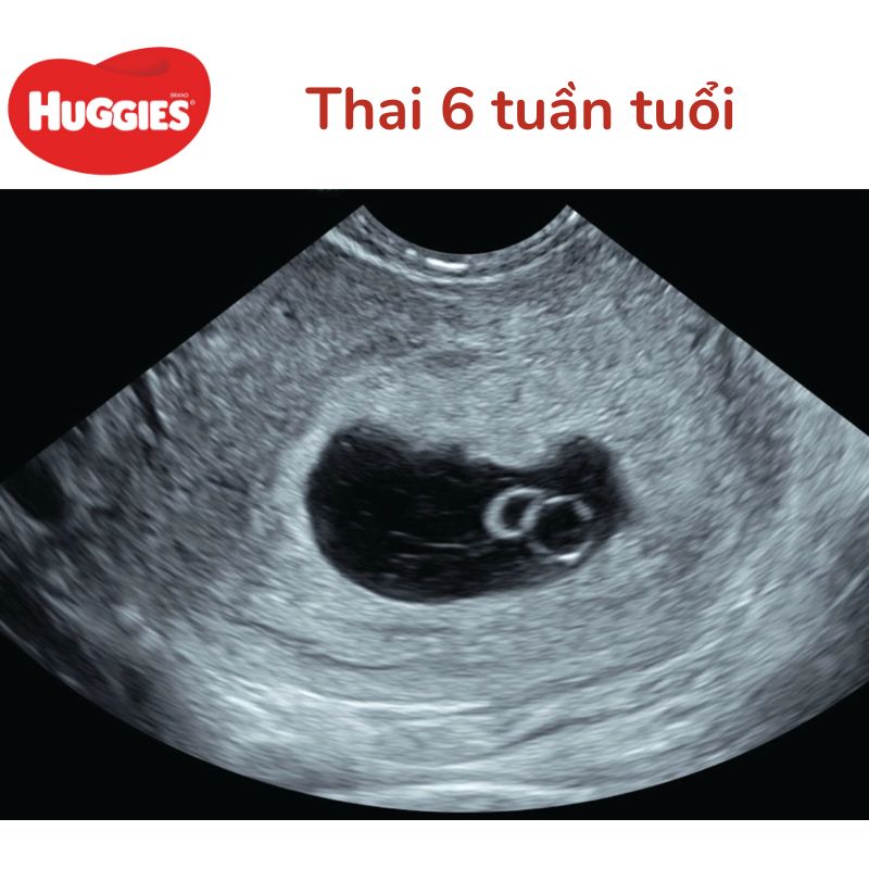 Hình ảnh siêu âm thai 6 tuần tuổi