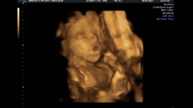 Hình ảnh siêu âm 4D thai 22 tuần tuổi 