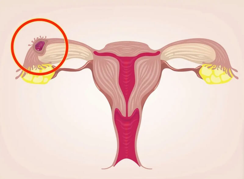  Nguyên nhân chính dẫn đến mang thai ngoài tử cung là do tổn thương ống dẫn trứng