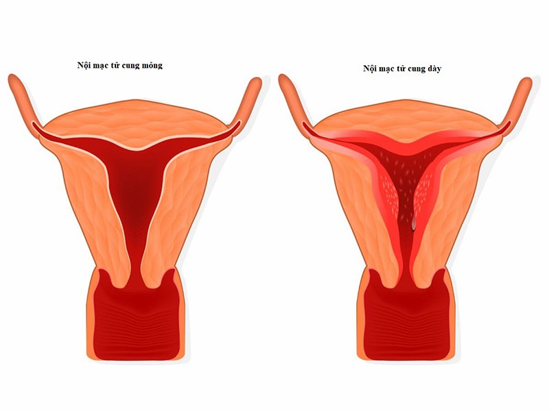 Độ dày niêm mạc tử cung và ảnh hưởng tới khả năng thụ thai