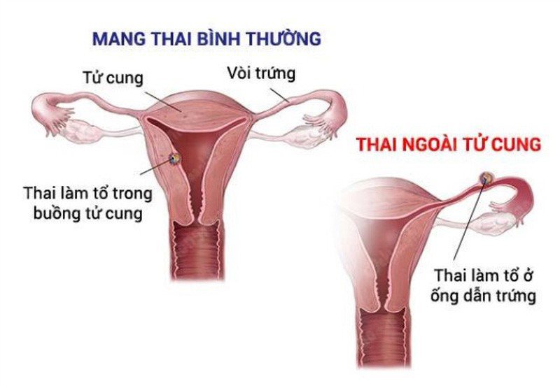 mổ thai ngoài tử cung có sinh thường được không