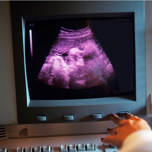 Siêu âm thai 7 tuần tuổi: Hình ảnh, Nhịp tim & Dấu hiệu khỏe mạnh