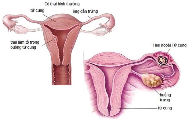 Thai chưa vào tử cung - Thai ngoài tử cung