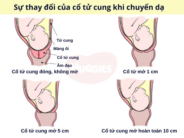 Sự thay đổi của cổ tử cung trong quá trình chuyển dạ sinh con