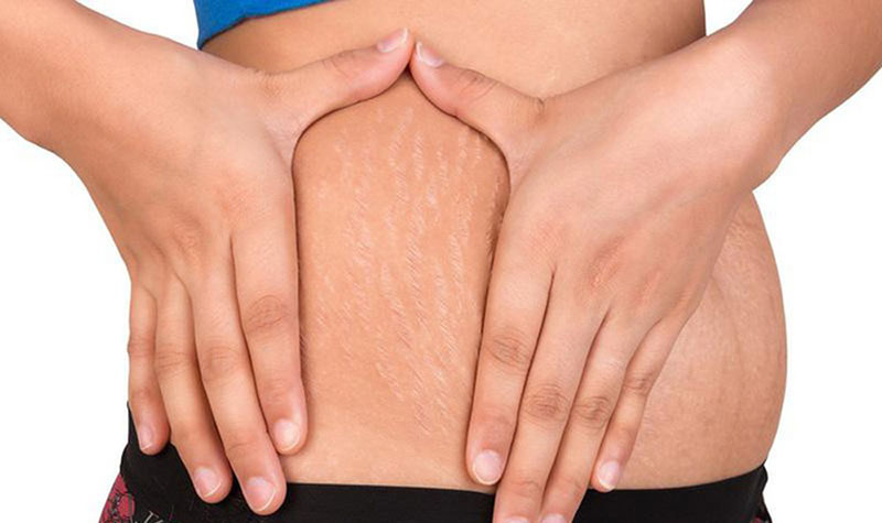 Bật mí cách trị rạn da & các mẹo làm đẹp sau sinh đơn giản