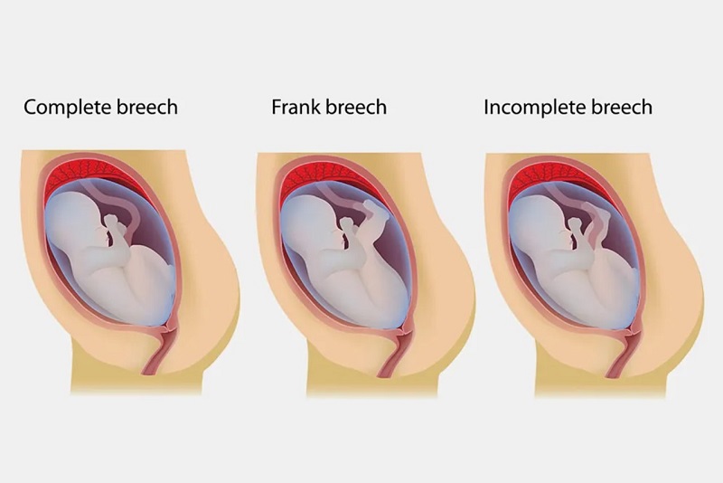 Có 3 loại ngôi thai ngược phổ biến