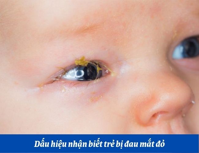 Chảy mủ từ mắt là một trong những dấu hiệu nhận biết trẻ bị đau mắt đỏ