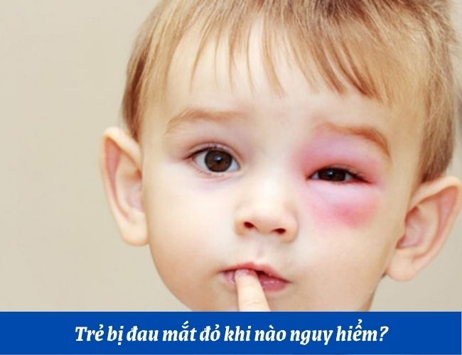 Trẻ bị đau mắt đỏ khi nào thì nguy hiểm