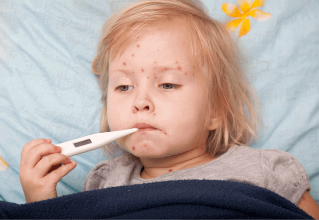 Dấu hiệu nhận biết bệnh chân tay miệng ở trẻ em