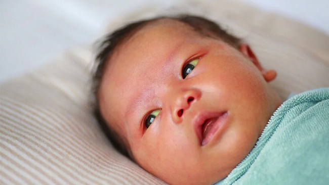 Vàng da ở trẻ sơ sinh là hiện tượng thường gặp ở trẻ sinh non, thiếu tháng