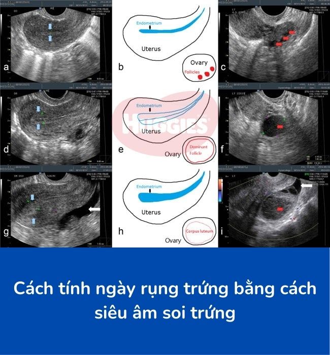 Cách tính ngày rụng trứng bằng siêu âm soi trứng 