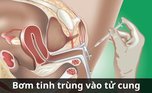 Bơm tinh tình vào tử cung sẽ giúp tăng cao khả năng mang thai