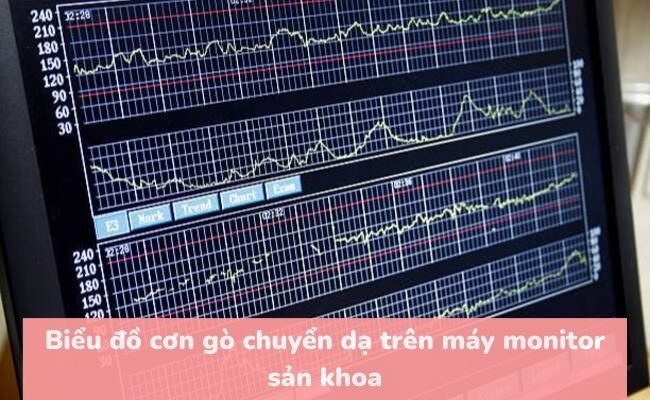 Cơn gò chuyển dạ là gì?