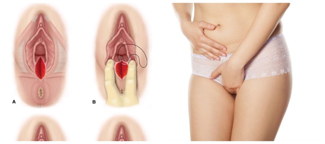Vết khâu ít chảy máu