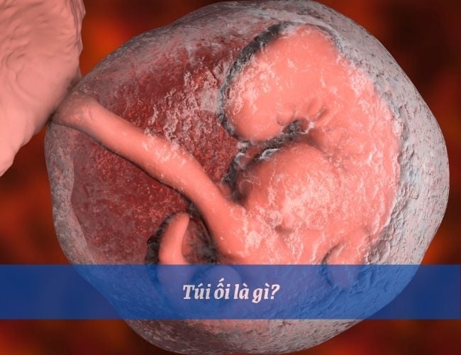 Vỡ ối là gì? Những điều mẹ bầu cần biết