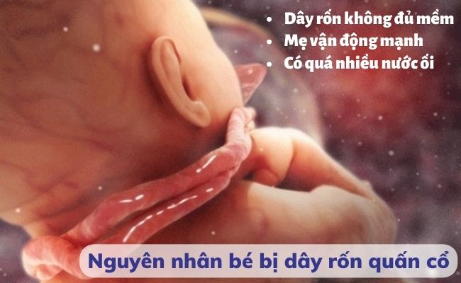 Một trong những nguyên nhân chủ yếu khiến bé bị dây rốn quấn cổ là do dây rốn dài hơn mức bình thường