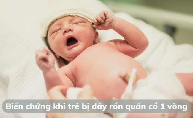 Những biến chứng trẻ và mẹ có thể gặp khi thai nhi bị dây rốn quấn cổ 1 vòng