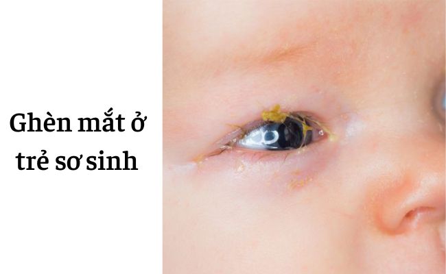 Ghèn mắt ở trẻ sơ sinh