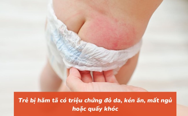 Trẻ bị hăm tã có triệu chứng đỏ da, kén ăn, mất ngủ hoặc quấy khóc