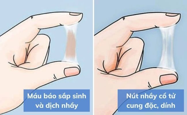 Hình ảnh máu báo sắp sinh và nút nhầy cổ tử cung