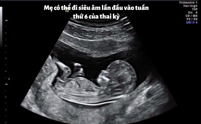 Thai nhi tuần 9 -10 của thai kỳ mẹ đã có thể nghe được tim thai của bé nhờ vào kỹ thuật siêu âm