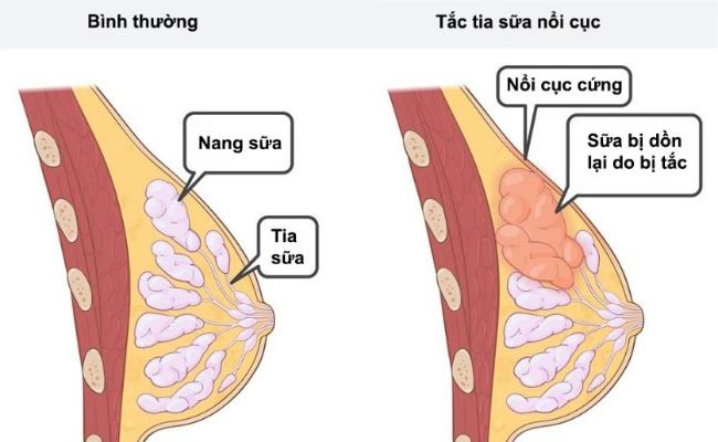 tắc tia sữa là gì