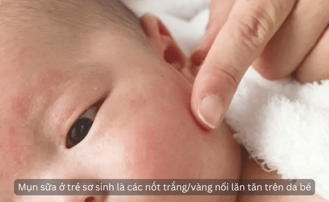 Mụn sữa ở trẻ sơ sinh là một bệnh lý thường xuyên xảy ra ở trẻ sơ sinh