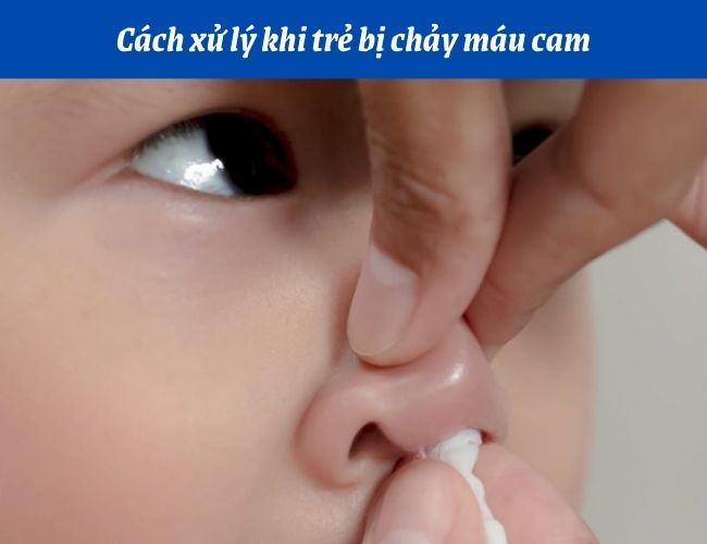 Cách xử lý khi trẻ bị chảy máu cam