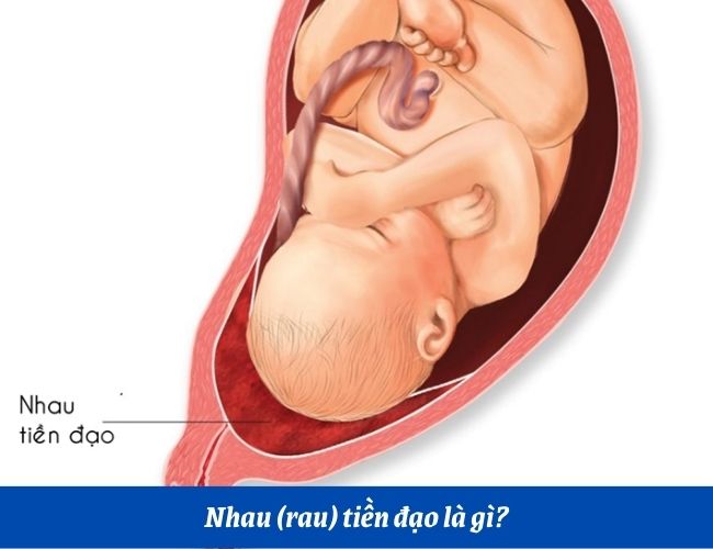 Nhau tiền đạo là tình trạng một phần hoặc tất cả bánh nhau nằm vắt ngang qua cổ tử cung