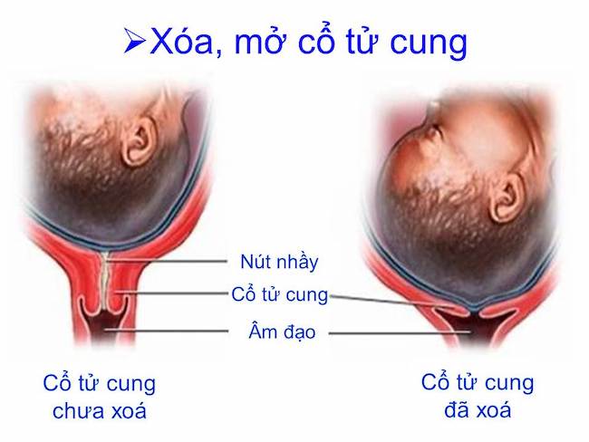 Mất nút nhầy